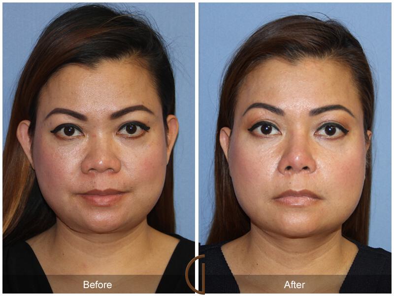 Female Rhinoplasty Before & After Photo