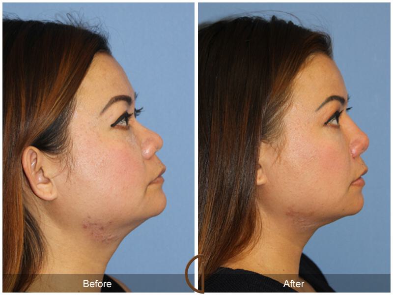 Female Rhinoplasty Before & After Photo