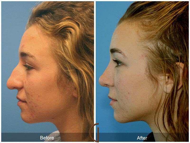 Female Rhinoplasty Before & After Photo