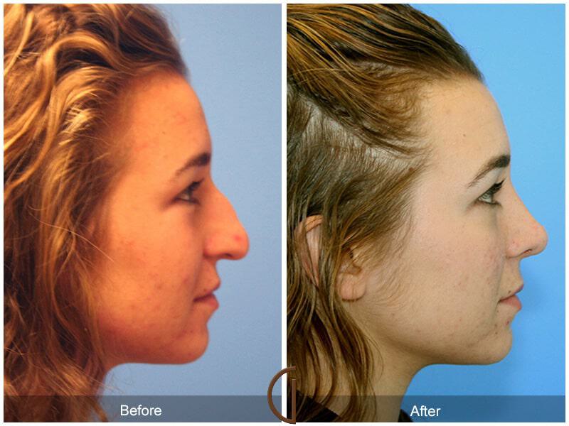 Female Rhinoplasty Before & After Photo