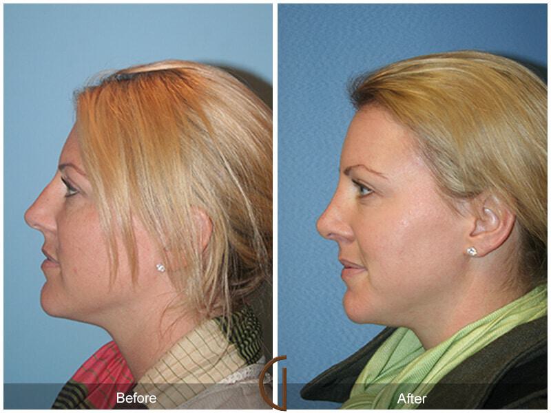 Female Rhinoplasty Before & After Photo