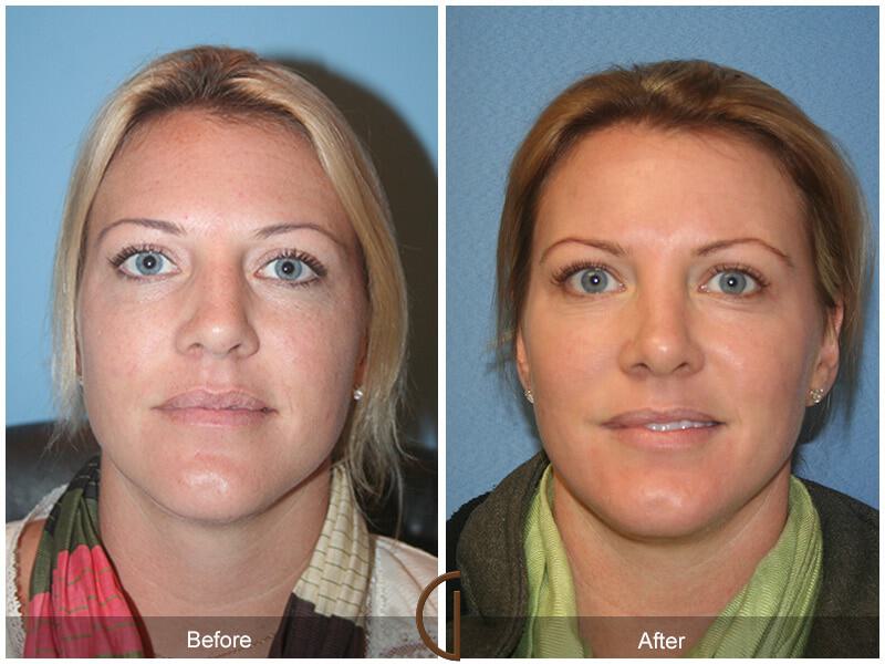 Female Rhinoplasty Before & After Photo