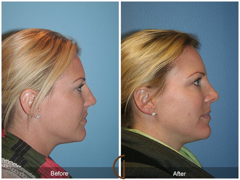 Female Rhinoplasty Before & After Photo