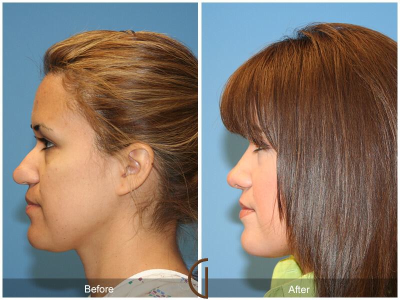 Female Rhinoplasty Before & After Photo