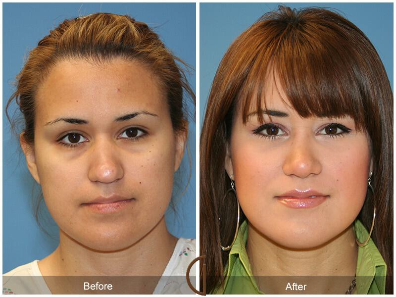 Female Rhinoplasty Before & After Photo