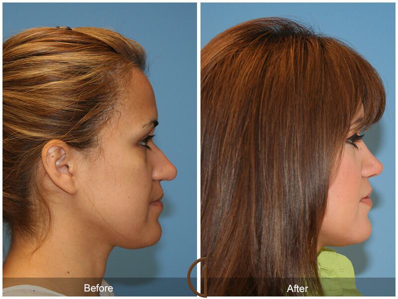 Female Rhinoplasty Before & After Photo