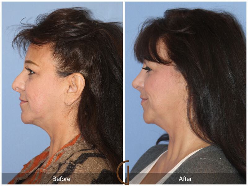 Female Rhinoplasty Before & After Photo