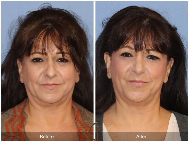 Female Rhinoplasty Before & After Photo