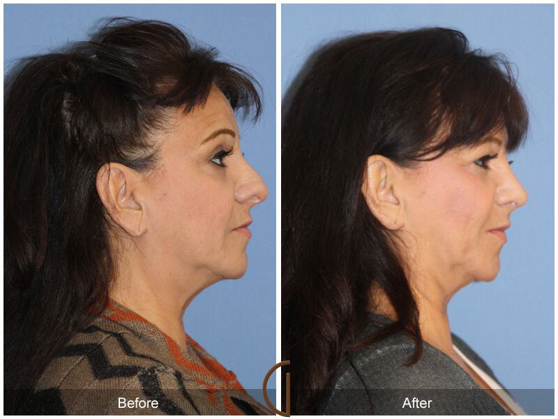 Female Rhinoplasty Before & After Photo