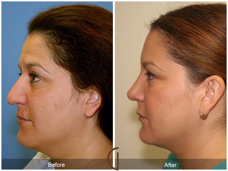 Female Rhinoplasty Before & After Photo