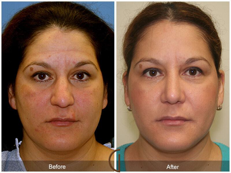 Female Rhinoplasty Before & After Photo