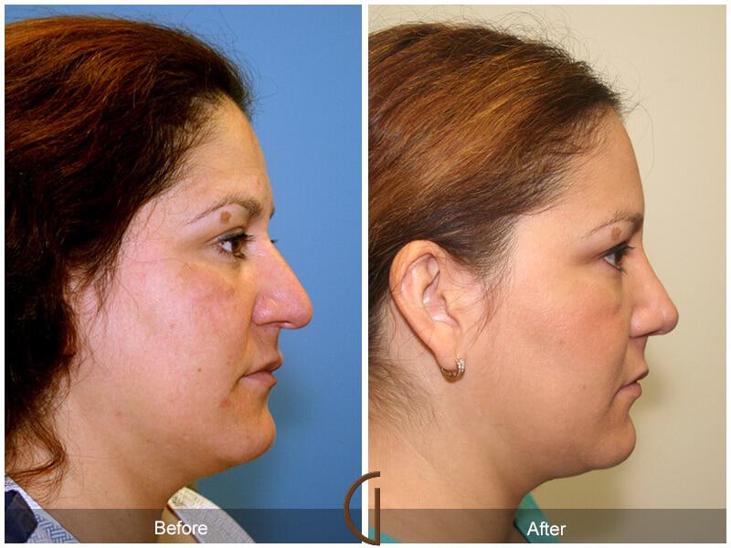 Female Rhinoplasty Before & After Photo