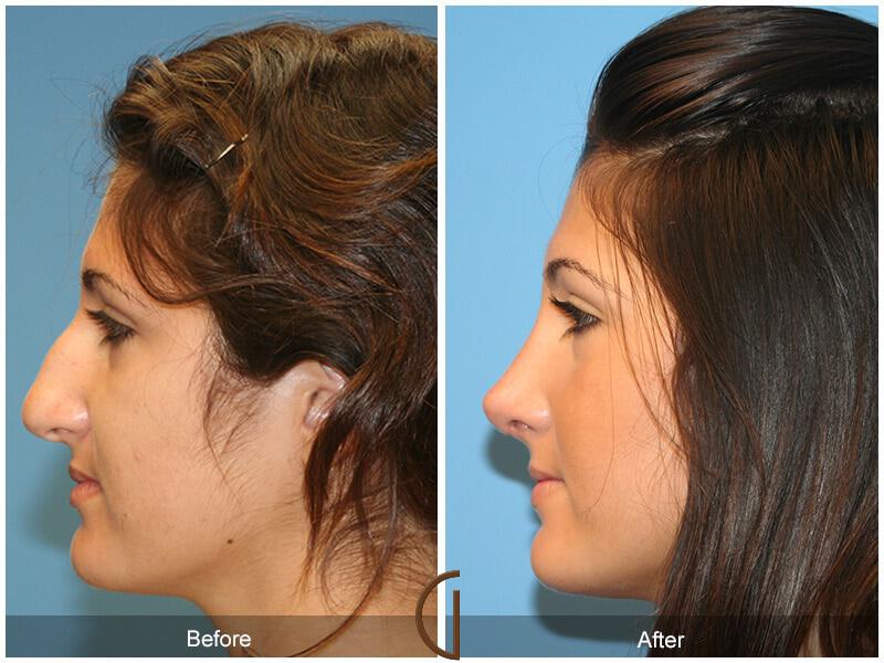 Female Rhinoplasty Before & After Photo