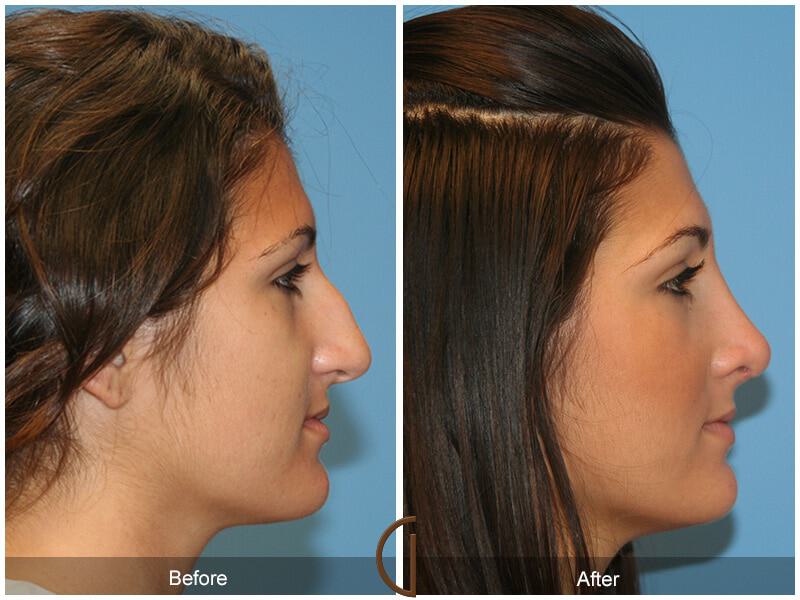 Female Rhinoplasty Before & After Photo