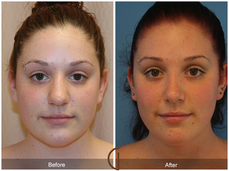 Female Rhinoplasty Before & After Photo