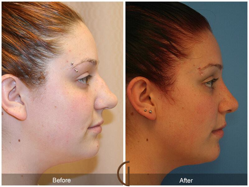 Female Rhinoplasty Before & After Photo