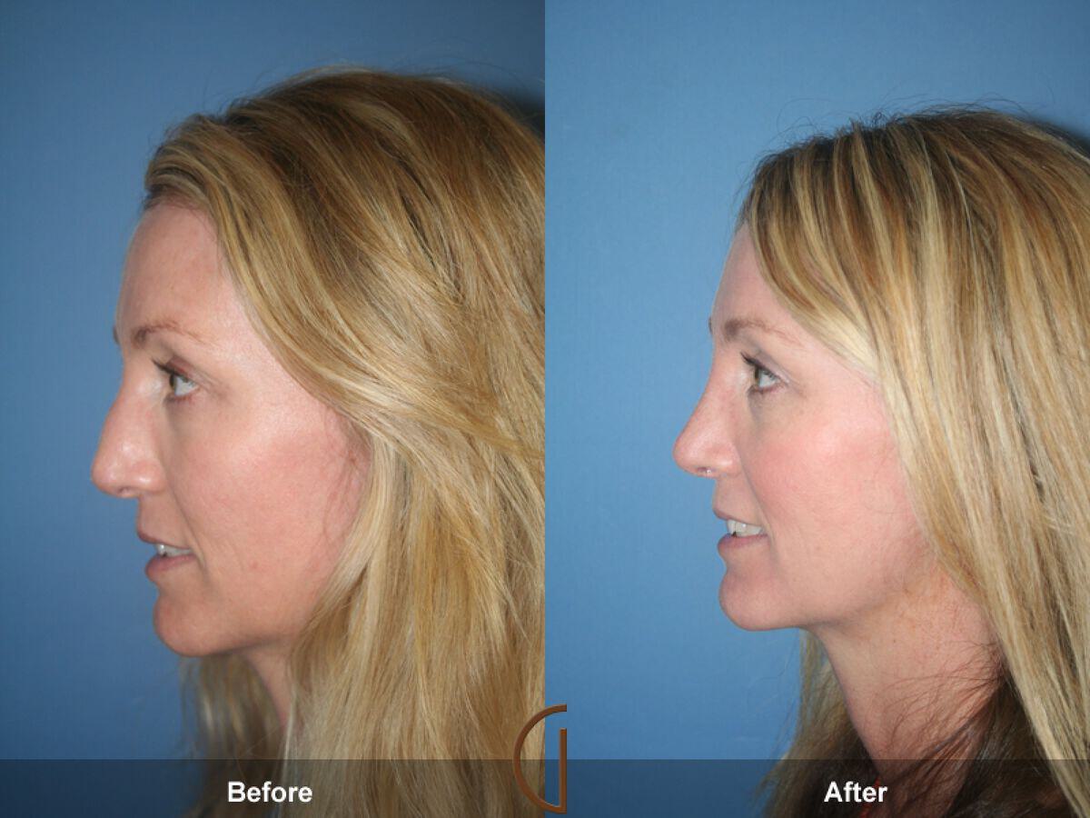 Female Rhinoplasty Before & After Photo