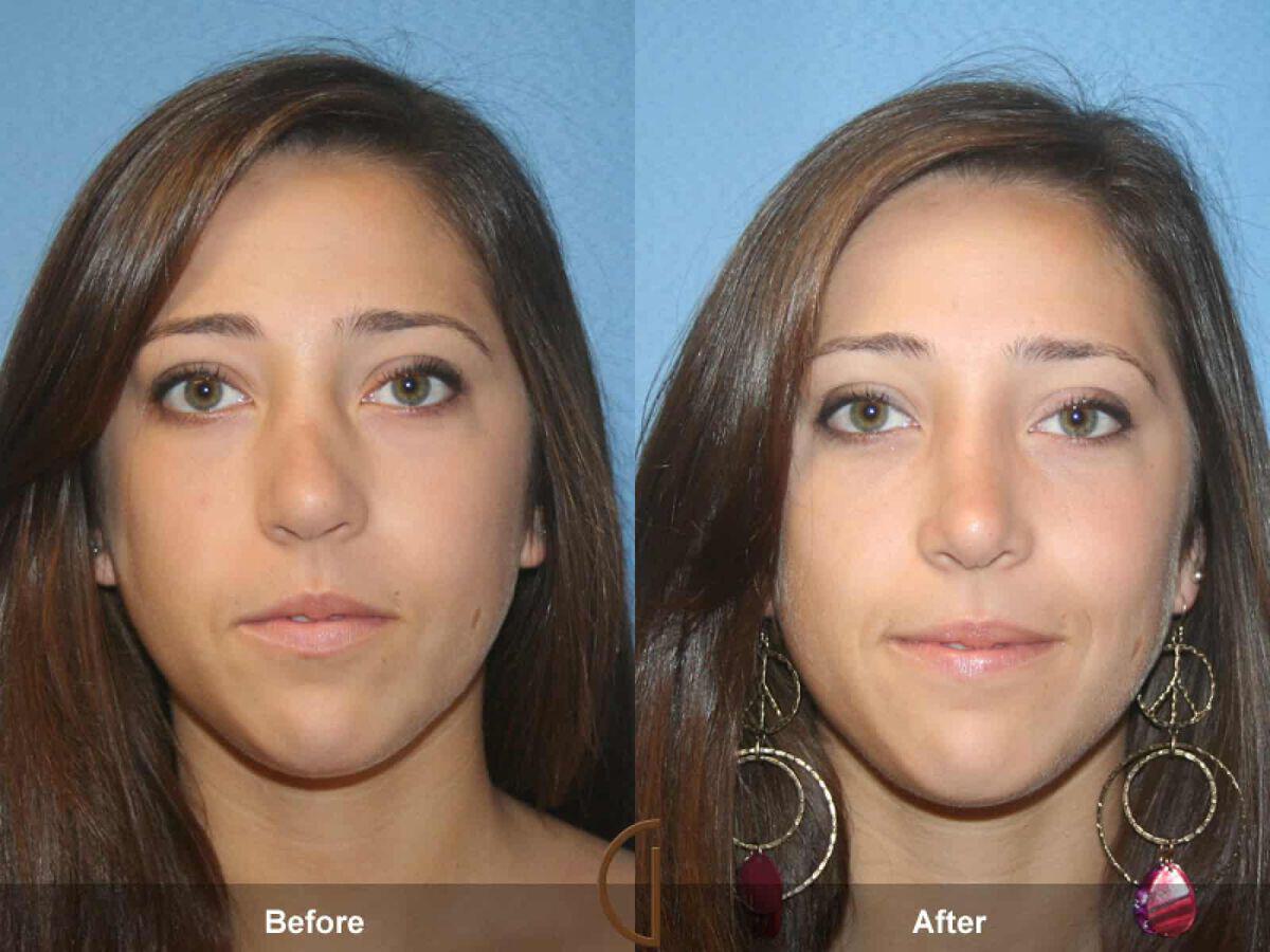 Female Rhinoplasty Before & After Photo