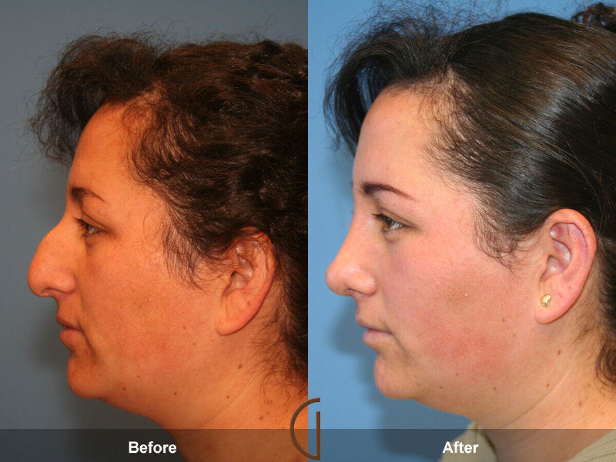 Female Rhinoplasty Before & After Photo