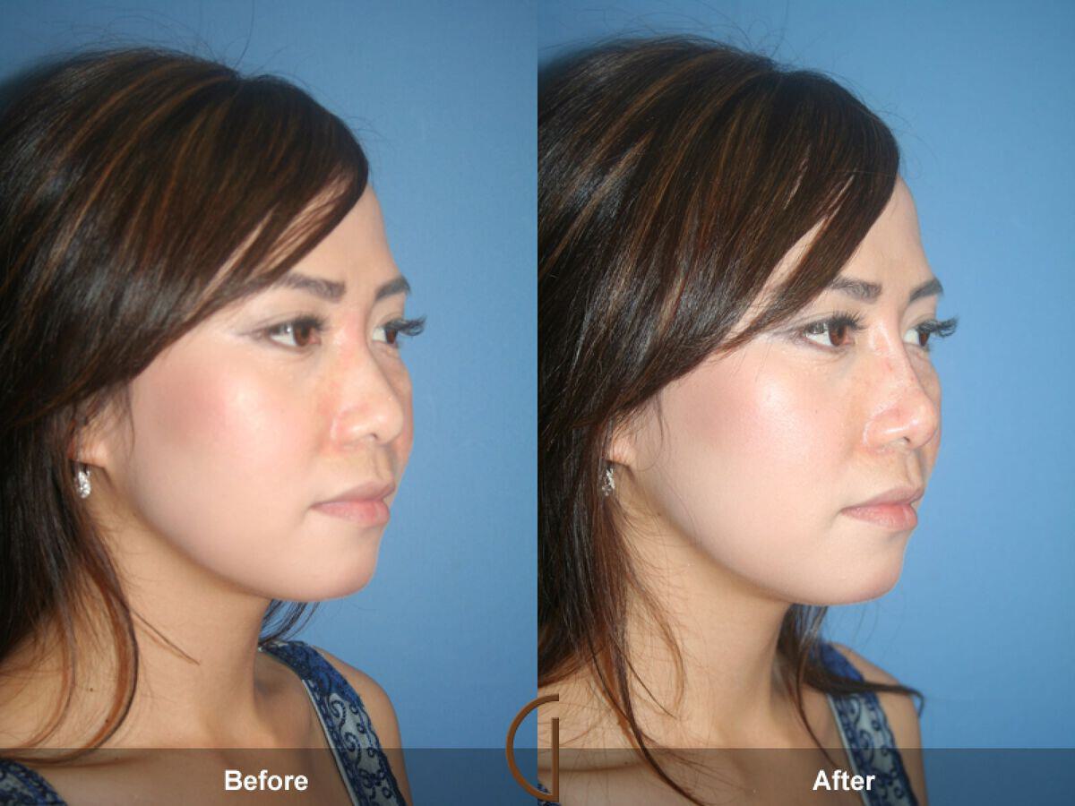 Female Rhinoplasty Before & After Photo