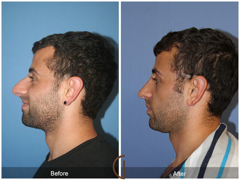 Male Rhinoplasty Before & After Photo