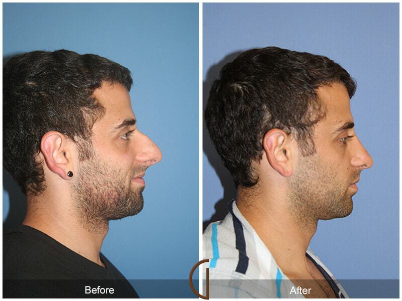 Male Rhinoplasty Before & After Photo