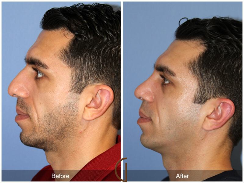 Male Rhinoplasty Before & After Photo