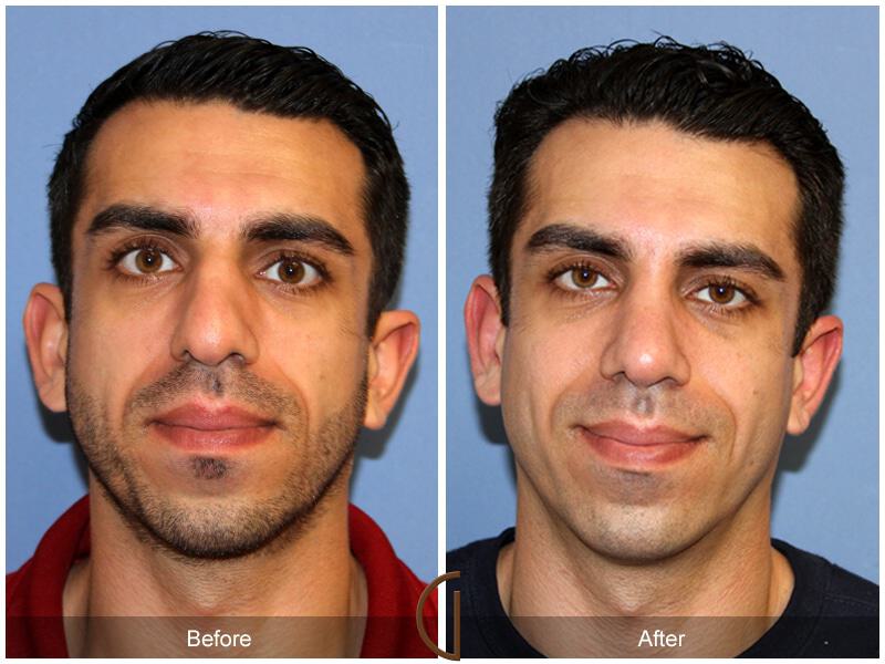 Male Rhinoplasty Before & After Photo