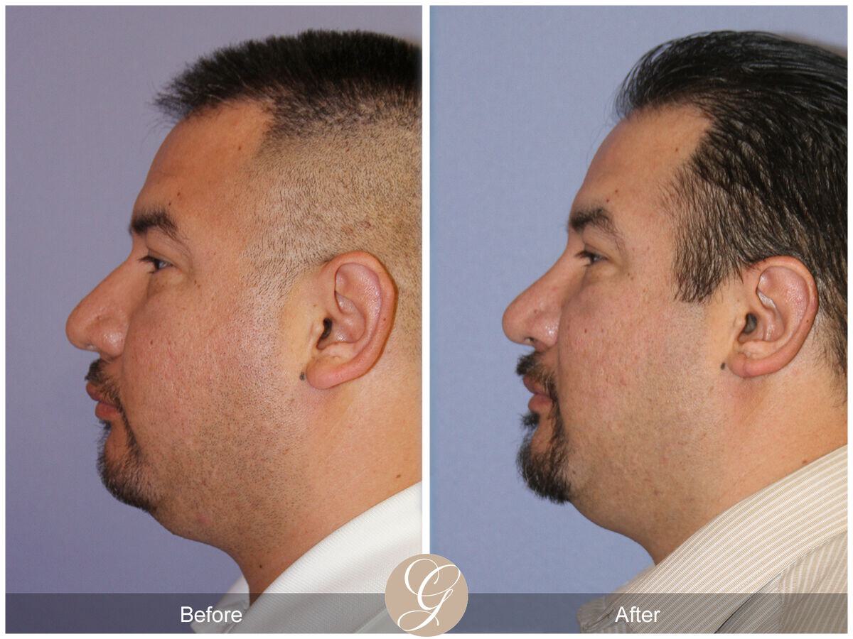 Male Rhinoplasty Before & After Photo