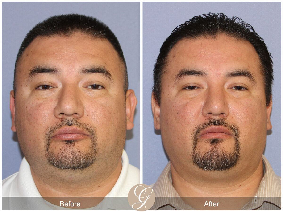 Male Rhinoplasty Before & After Photo