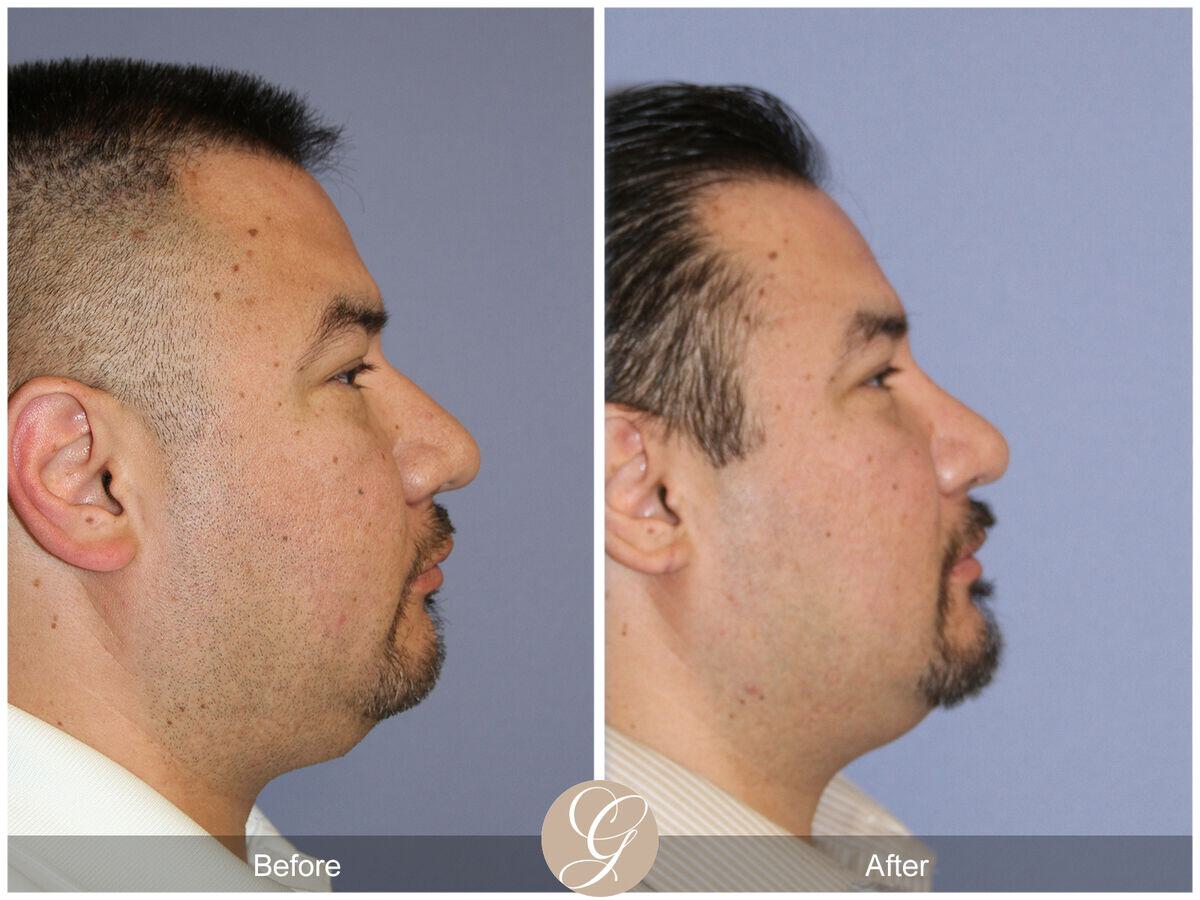 Male Rhinoplasty Before & After Photo