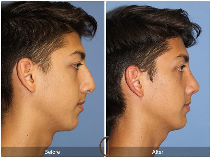 Male Rhinoplasty Before & After Photo