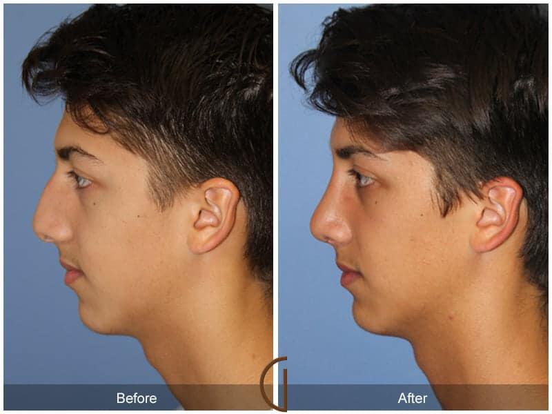 Male Rhinoplasty Before & After Photo