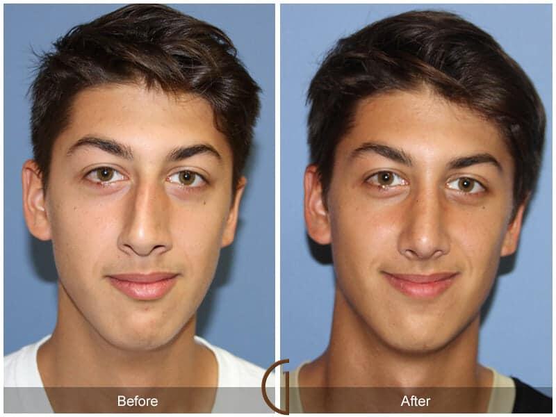 Male Rhinoplasty Before & After Photo