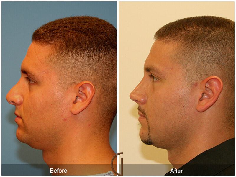 Male Rhinoplasty Before & After Photo