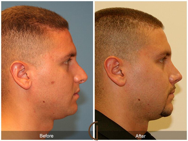 Male Rhinoplasty Before & After Photo