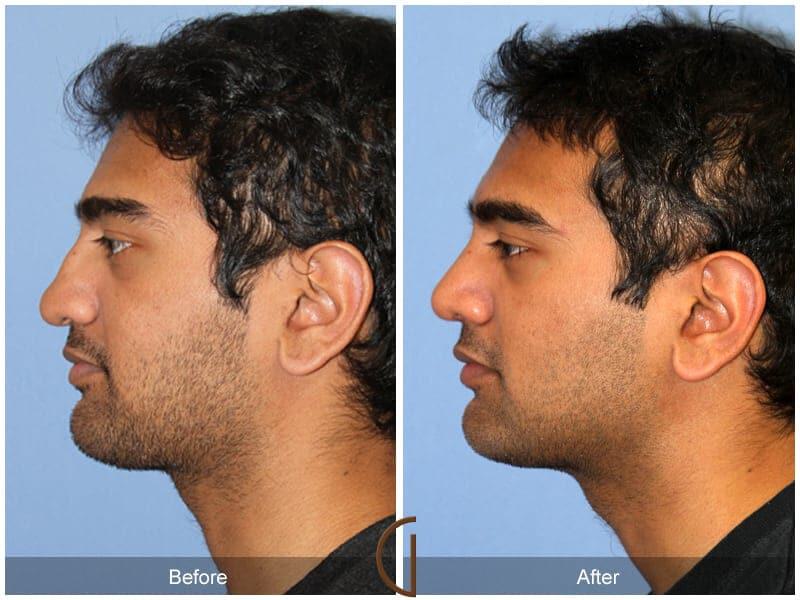 Male Rhinoplasty Before & After Photo