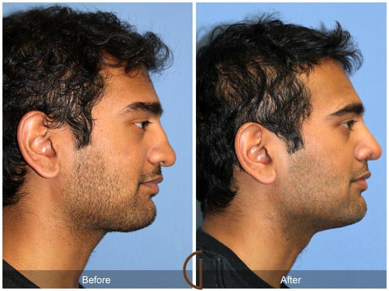 Male Rhinoplasty Before & After Photo