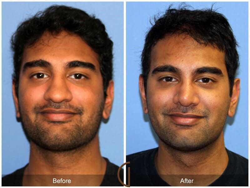 Male Rhinoplasty Before & After Photo