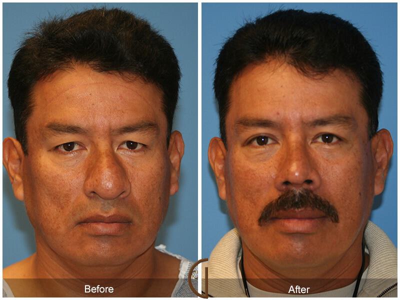 Male Rhinoplasty Before & After Photo