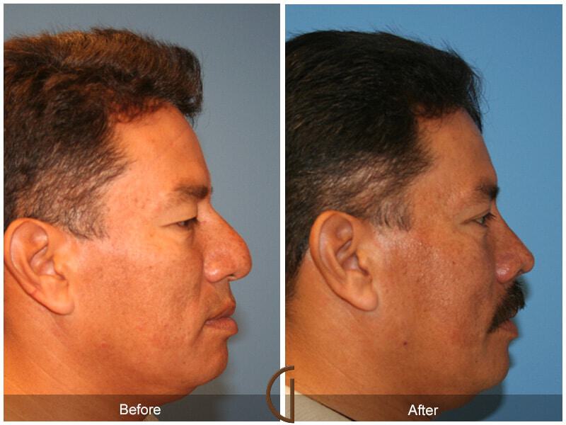 Male Rhinoplasty Before & After Photo