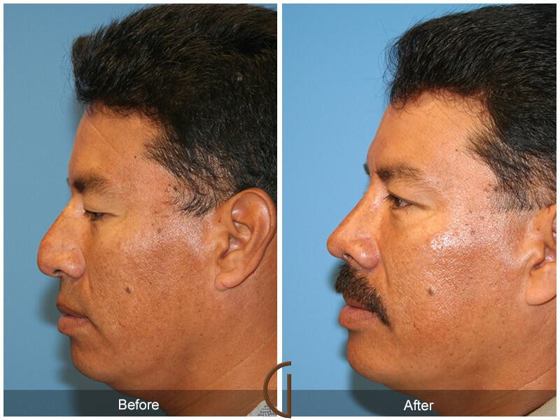 Male Rhinoplasty Before & After Photo