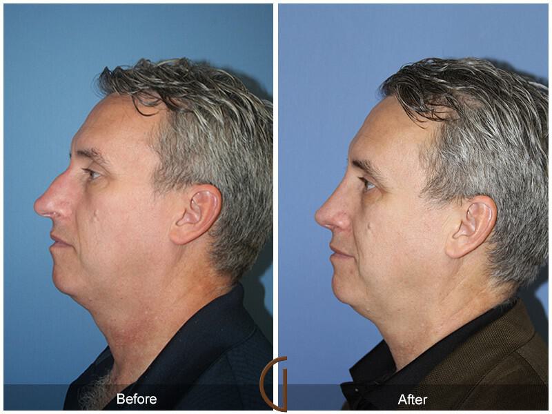 Male Rhinoplasty Before & After Photo