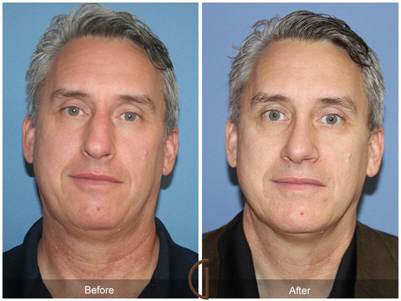 Male Rhinoplasty Before & After Photo