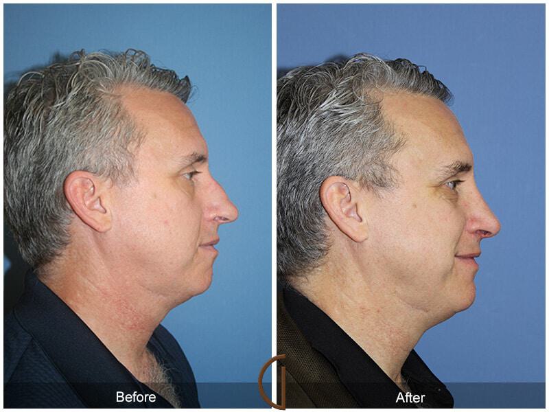 Male Rhinoplasty Before & After Photo