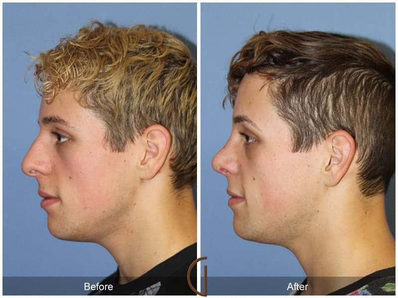 Male Rhinoplasty Before & After Photo