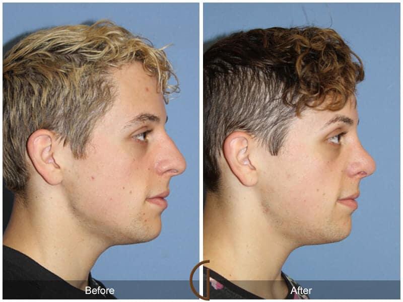 Male Rhinoplasty Before & After Photo