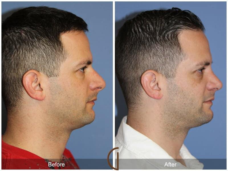 Male Rhinoplasty Before & After Photo