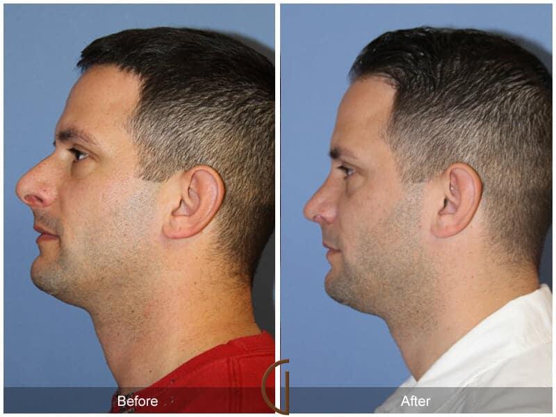 Male Rhinoplasty Before & After Photo