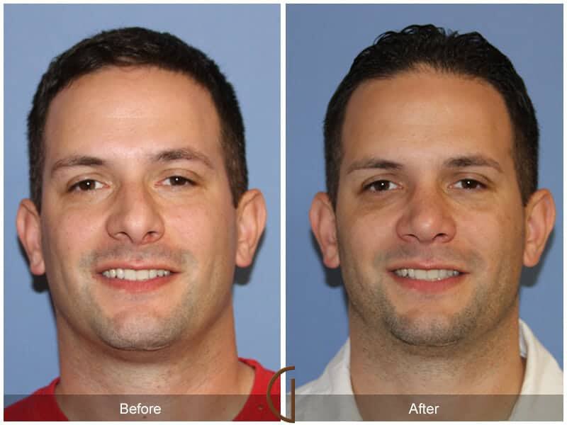 Male Rhinoplasty Before & After Photo